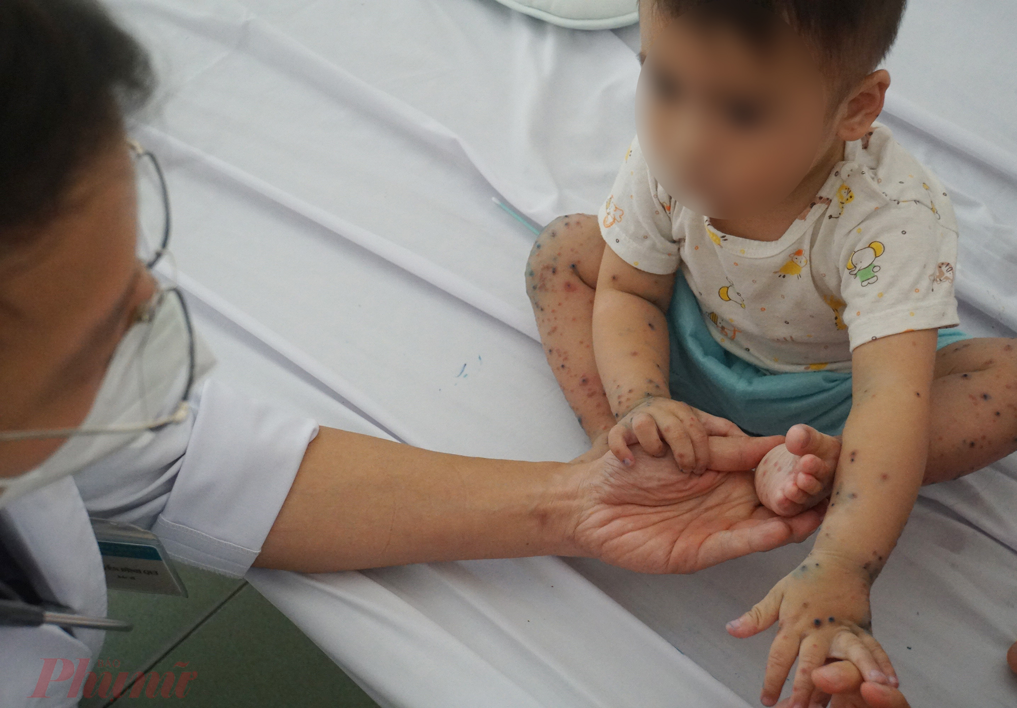 Theo ghi nhận của phóng viên Báo Phụ nữ TPHCM, có trẻ bị sốt hơn 3 ngày, khi được đưa đến bệnh viện thì cơ thể đã nổi đầy bóng nước, ngứa ngấy, khó chịu