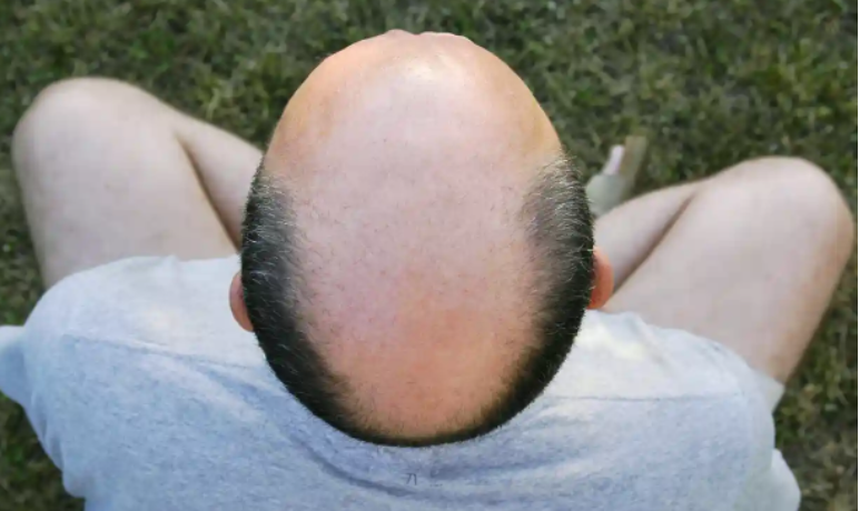 Nam giới thường bị chứng rụng tóc nhiều hơn phụ nữ