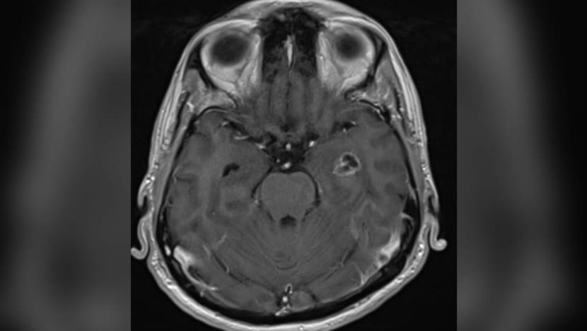Ảnh chụp cho thấy một khối u nhỏ phát triển tại phần não phải của Maideen, tại khu vực chịu trách nhiệm kiểm soát cảm xúc