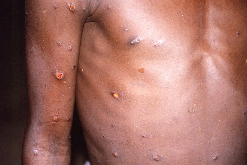 Bệnh đậu mùa khỉ là một bệnh nhiễm vi rút thường nhẹ. Các triệu chứng bao gồm sốt, đau đầu và phát ban trên da.