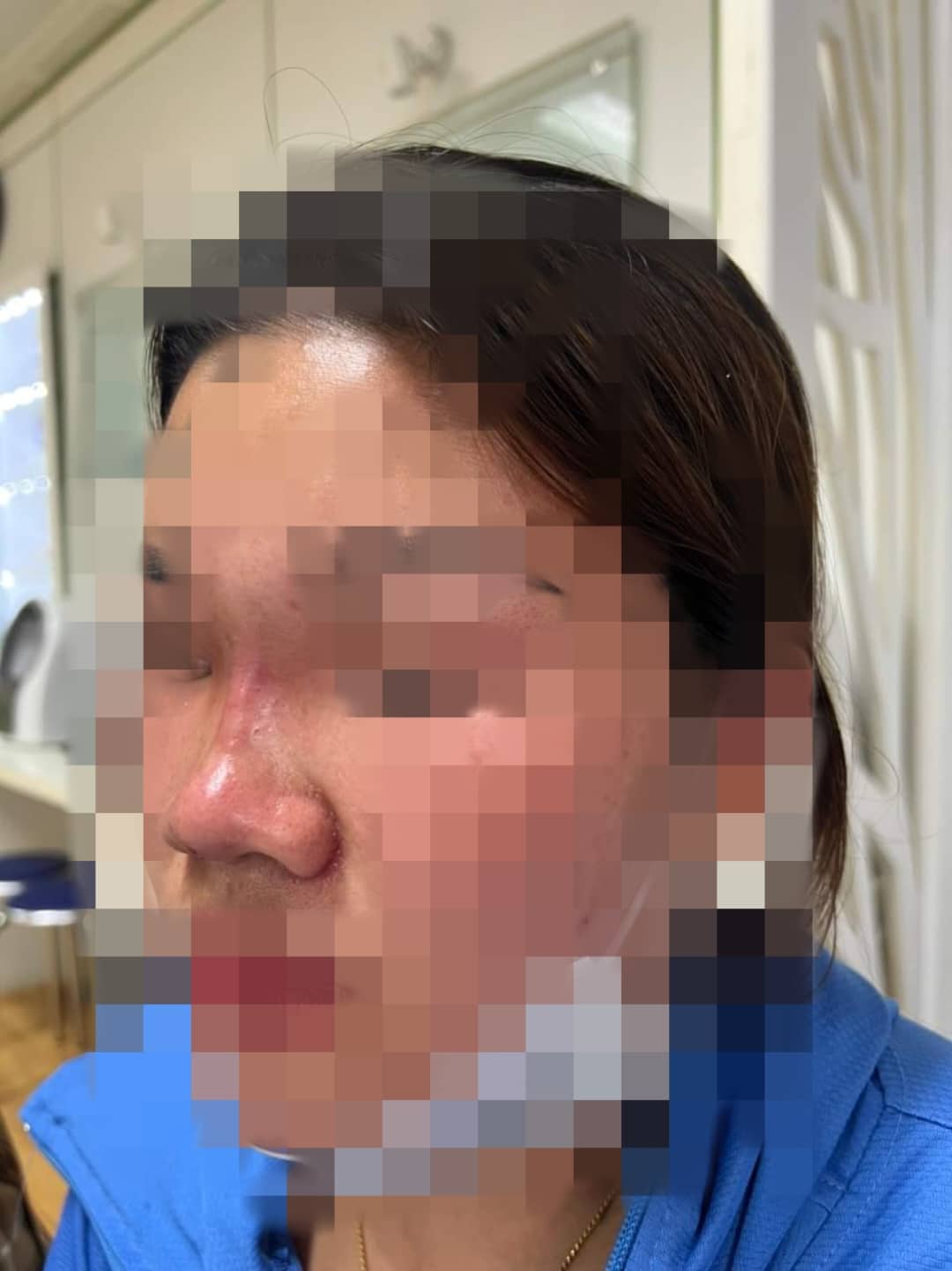 Phần mũi tiêm filler của nữ bệnh nhân tại Thanh Hóa bị sưng nề, đỏ ứng sau khi thực hiện tại spa (ảnh BSCC)