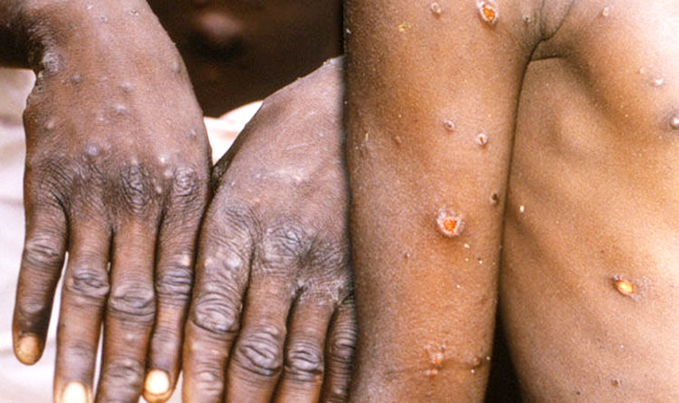 Triệu chứng bất thường của bệnh đậu mùa khỉ là phát ban trên mặt, sau đó lan ra các bộ phận khác của cơ thể - ẢNH: AFP