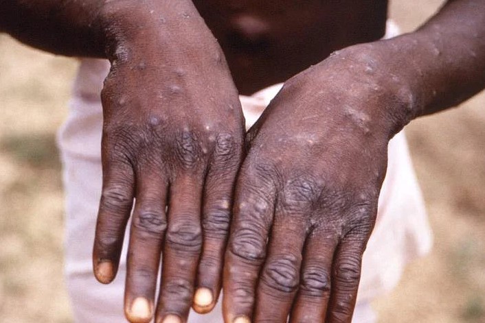Bệnh đậu mùa khỉ có thể gây ra các triệu chứng bao gồm sốt, đau nhức và phát ban sần sùi đặc biệt ở tay và chân