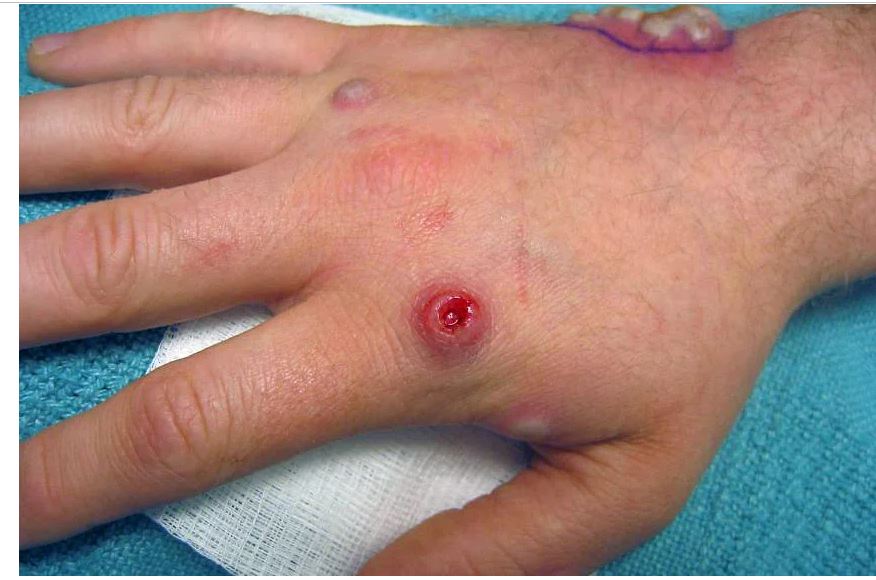 Mụn mủ được nhìn thấy trên bàn tay của một bệnh nhân đậu mùa khỉ