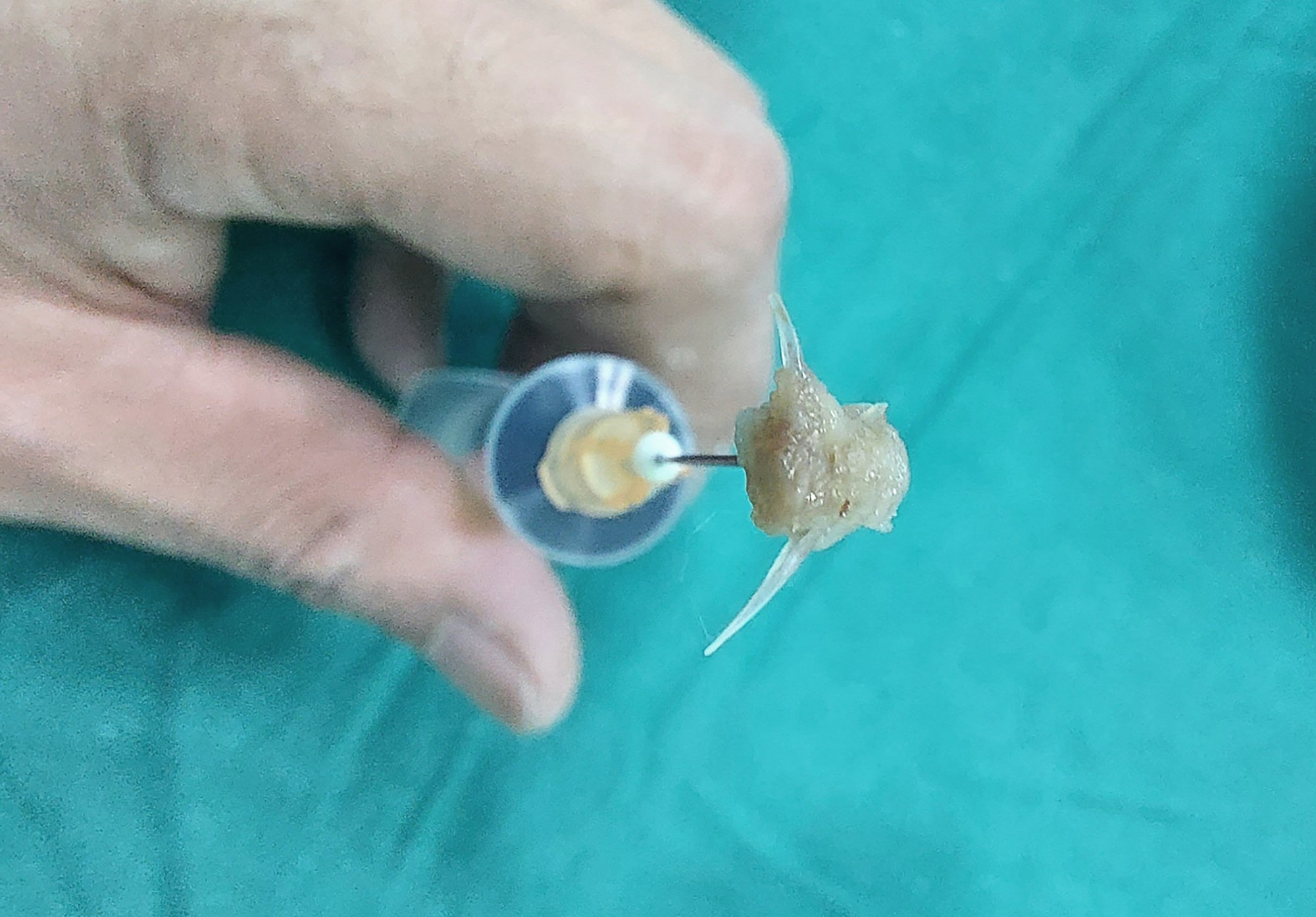 Mảnh xương cá sắc nhọn được lấy ra khỏi đường thở bé 2 tuổi