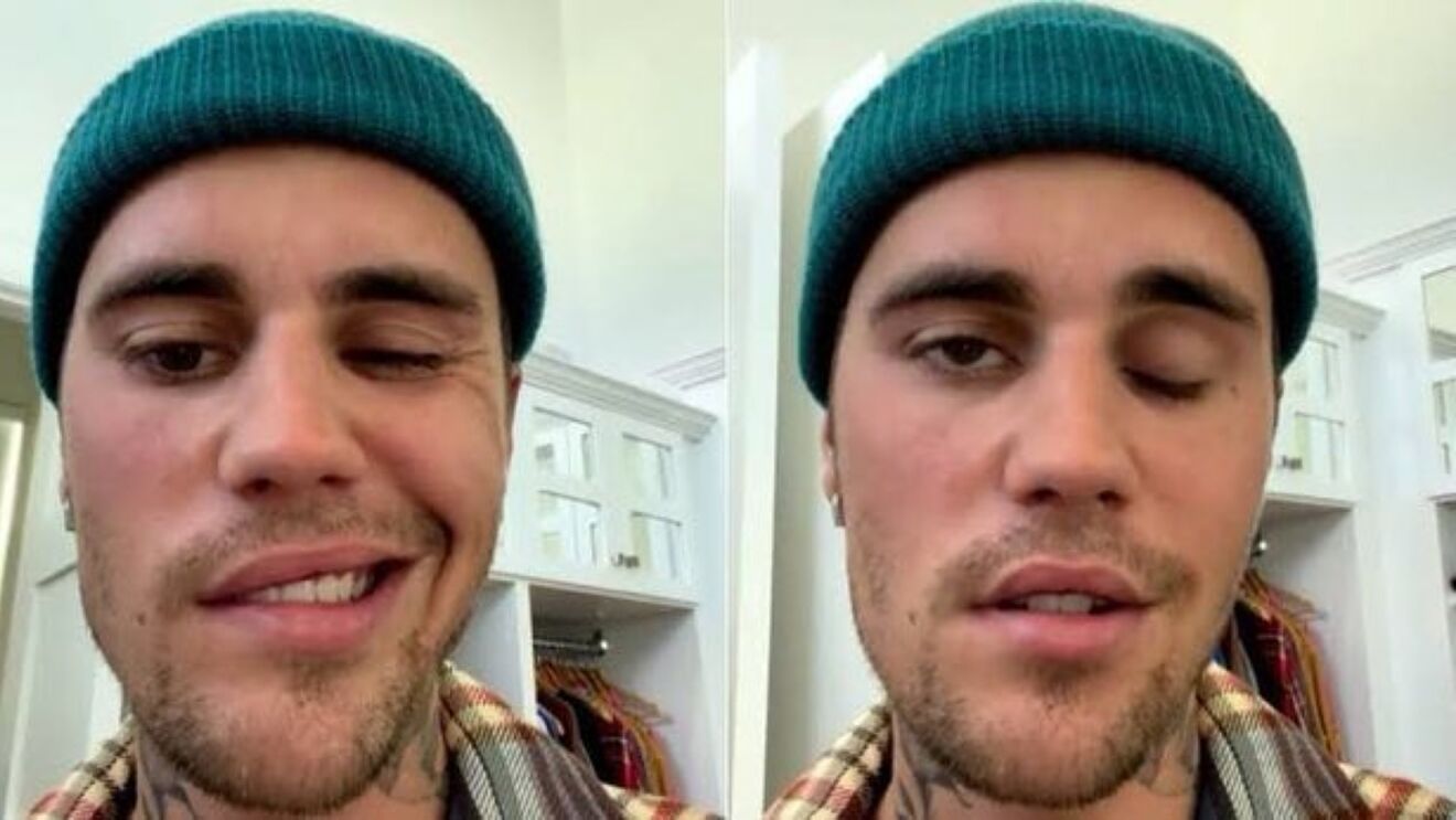 Justin Bieber cho biết một nửa bên mặt của anh gần như bị liệt, mắt trái không thể nháy