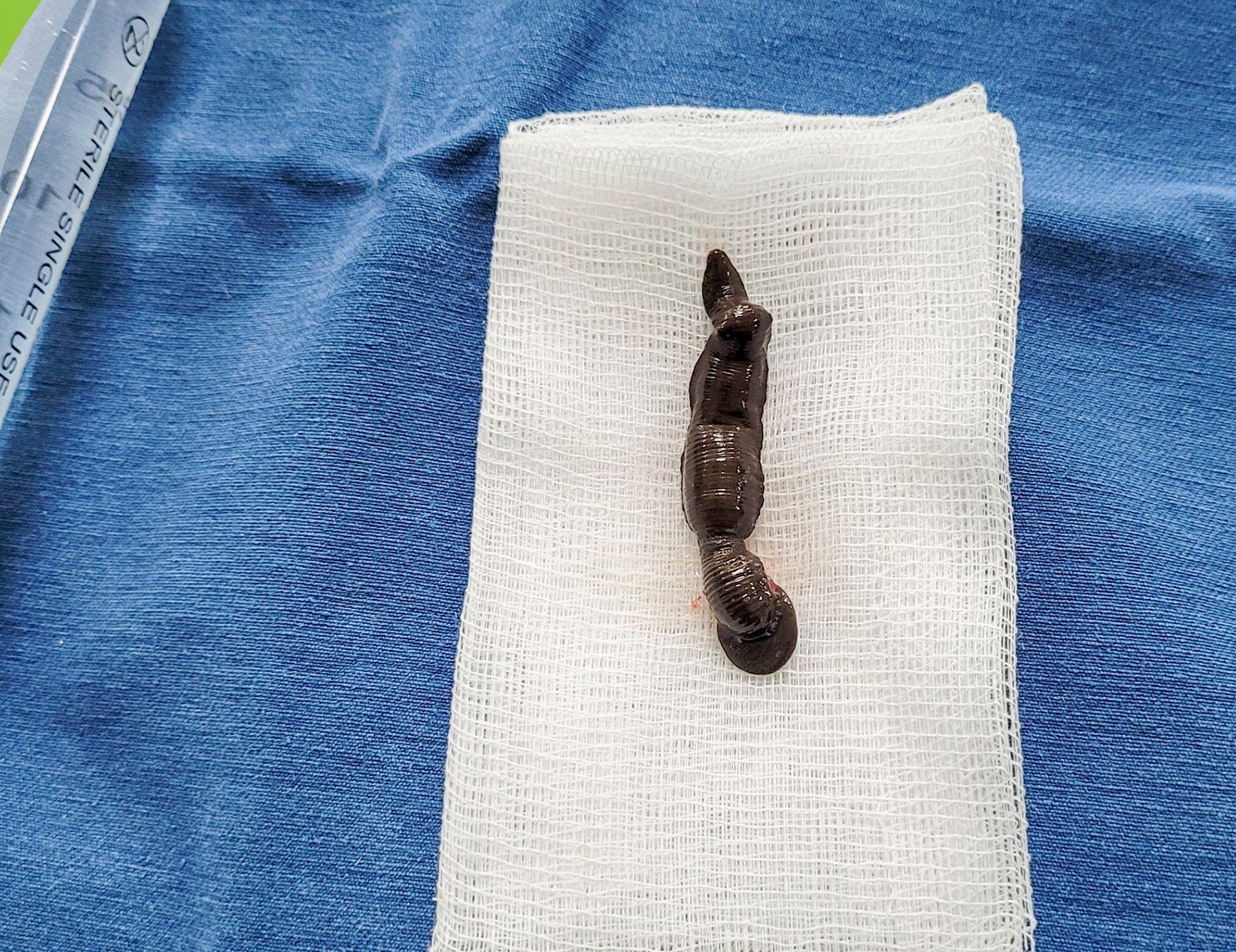 Con đỉa dài 4cm được các bác sĩ phẫu thuật nội soi gắp ra từ khí quản bệnh nhi