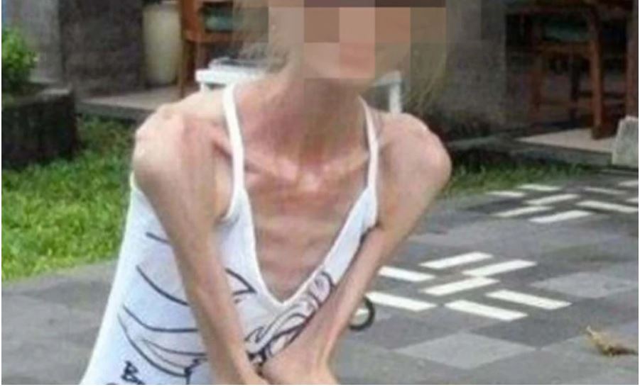 Một bà mẹ trẻ 2 con biếng ăn ở Trung Quốc nặng 25kg nhập viện ICU vì suy đa tạng