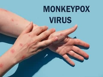 Theo WHO, những người mắc bệnh đậu mùa khỉ có thể lây truyền virus cho những người khác trong 4 tuần
