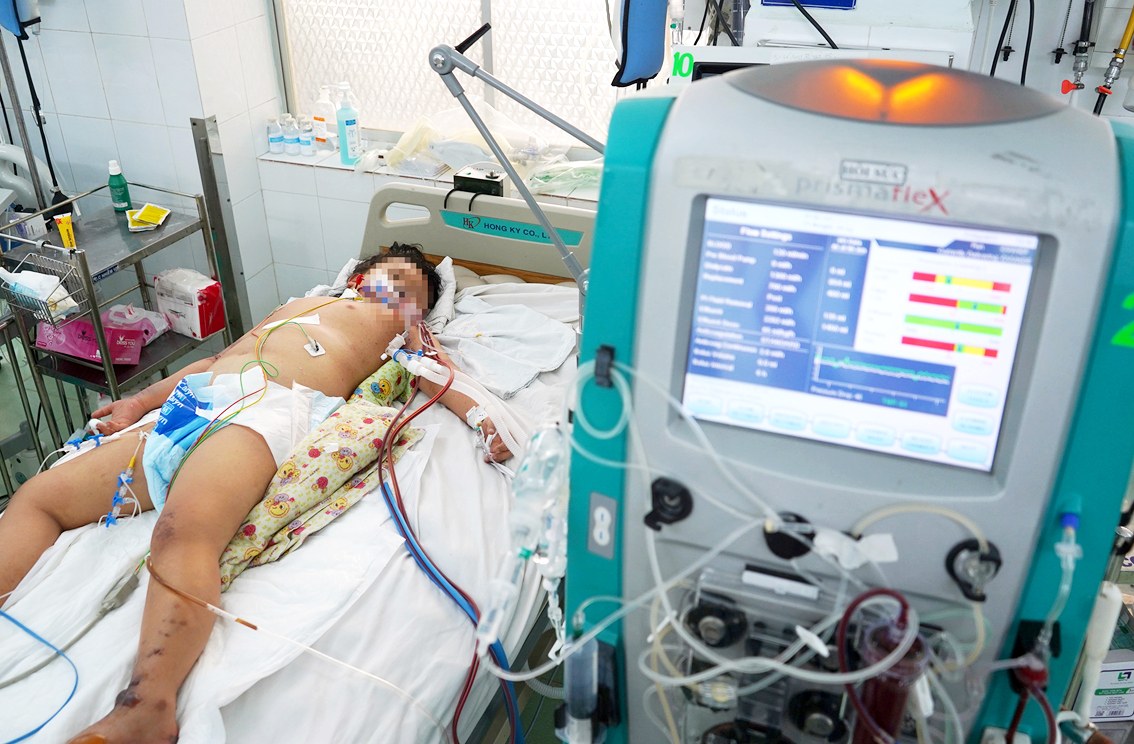 Trẻ thừa cân, bị sốt xuất huyết nặng phải lọc máu điều trị tại Bệnh viện Nhi Đồng 2 TP.HCM - ẢNH: PHẠM AN