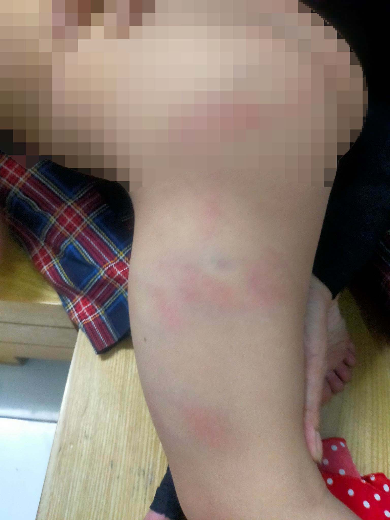 Vết thương trên cơ thể bé T. bị cô giáo đánh vì lý do đi vệ sinh trong quần
