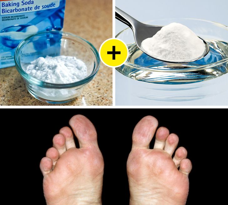 Thêm baking soda vào nước ngâm chân có thể giúp chữa lành vết chai, nhưng có một cách ít lộn xộn hơn. Trộn baking soda với nước để tạo thành hỗn hợp sền sệt và thoa lên vết chai thường xuyên cho đến khi chúng lành lại.