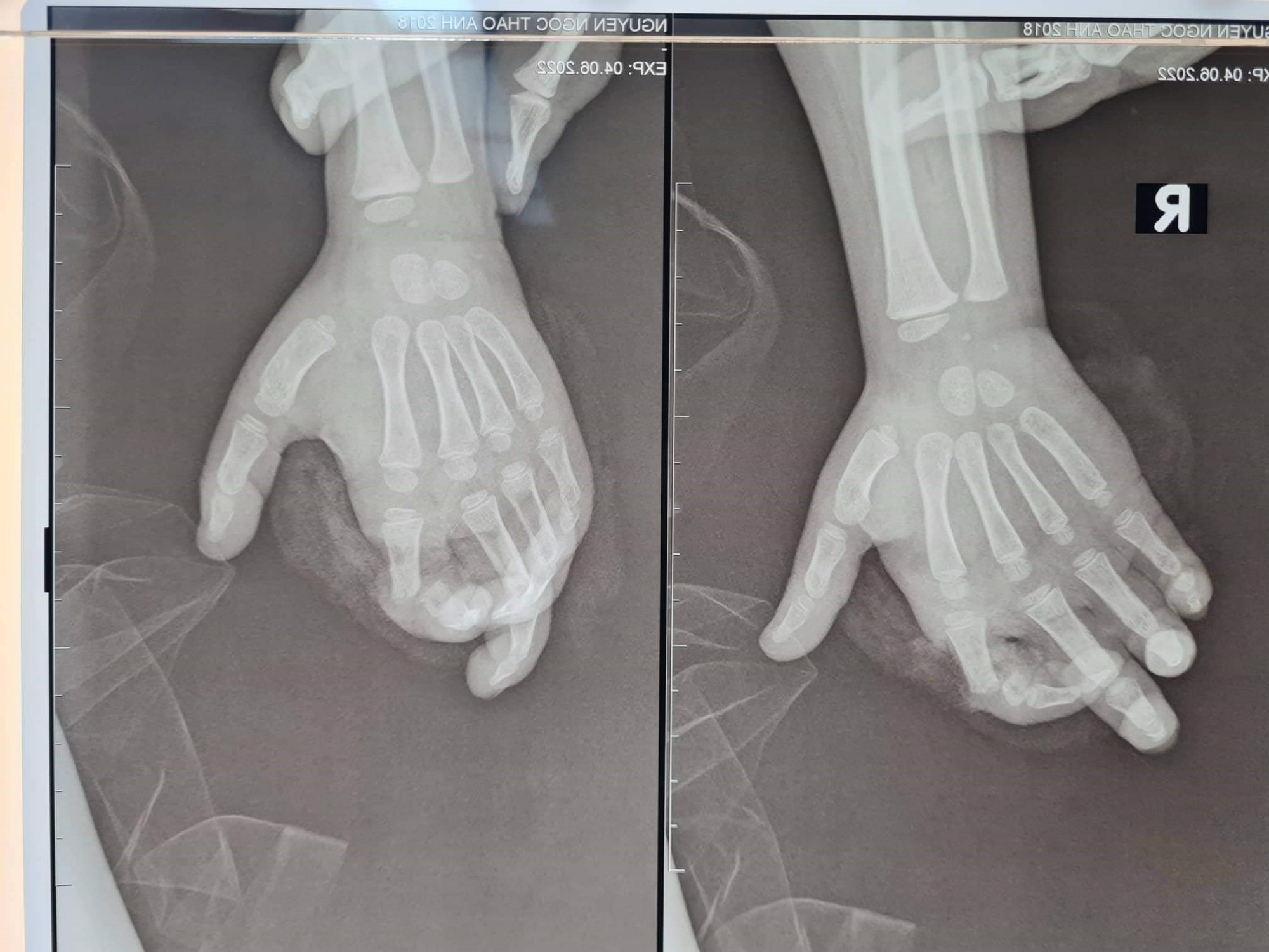 Hình ảnh ngón tay bị đứt của bé gái do nghịch máy xay khi đang hoạt động