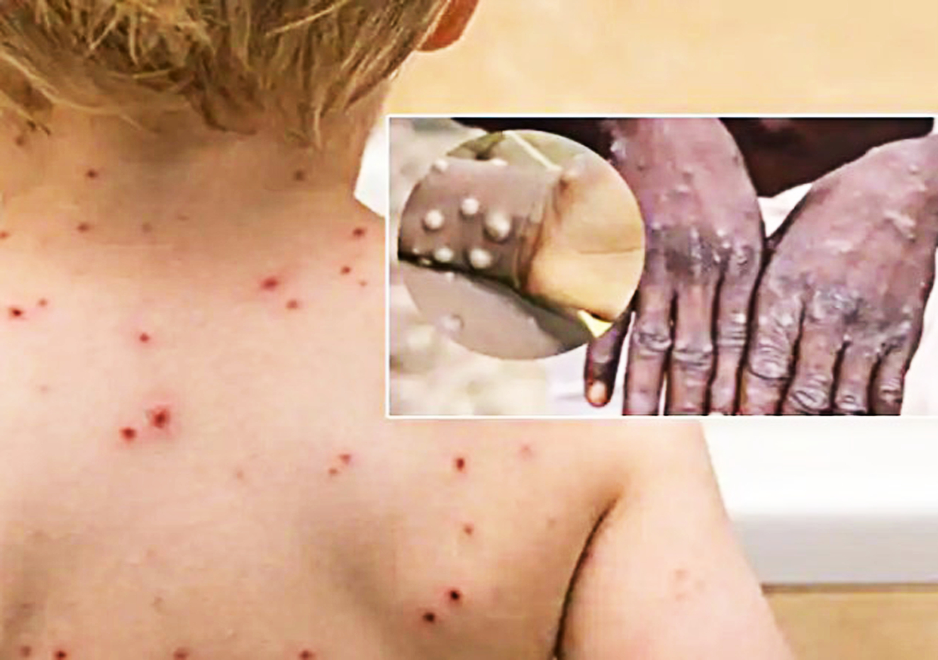 Hiện vắc-xin phòng bệnh đậu mùa được cho là có hiệu quả tốt trong việc chống lại đậu mùa khỉ - Ảnh: Getty Images