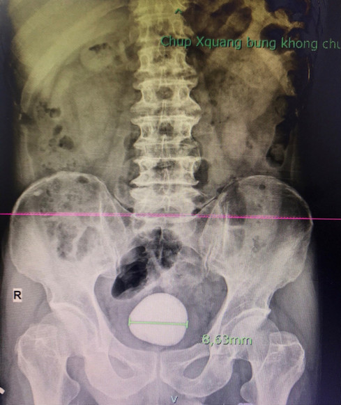 Hình ảnh chụp X-quang phát hiện sỏi bàng quang của bệnh nhân
