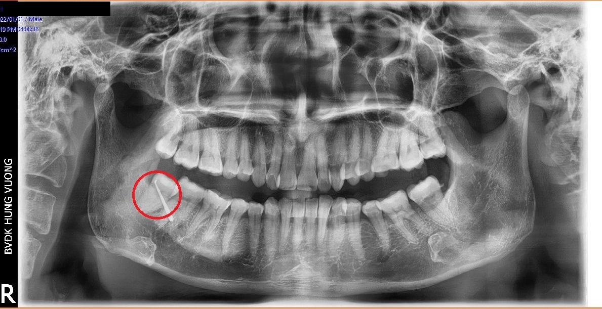 Hình ảnh răng khôn của bệnh nhân mọc lệch