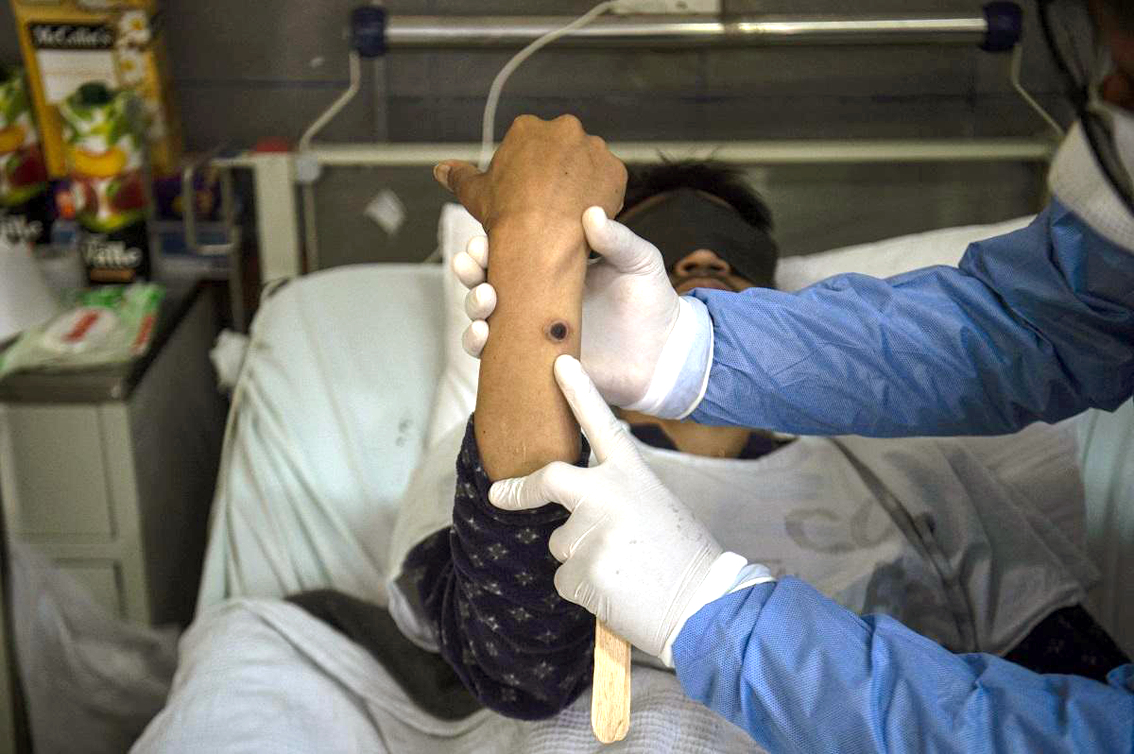 Bác sĩ đang khám cho một bệnh nhân bị lở loét do nhiễm trùng đậu mùa khỉ trong khu cách ly tại Bệnh viện Arzobispo Loayza, ở Lima, Peru - ẢNH: AFP