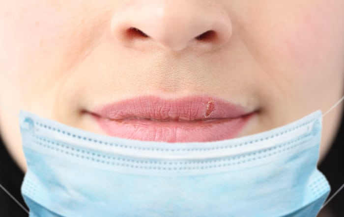 Nếu bạn thấy mình bị nứt nẻ môi ngứa, đó có thể là dấu hiệu của một tình trạng gọi là viêm môi. Nó thường xảy ra xung quanh viền môi, mặc dù da xung quanh và khoang miệng cũng có thể bị ảnh hưởng.