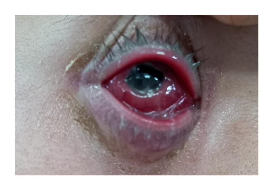 Nam thanh niên phát hiện bị lậu mắt sau nhiều ngày điều trị viêm kết mạc không khỏi