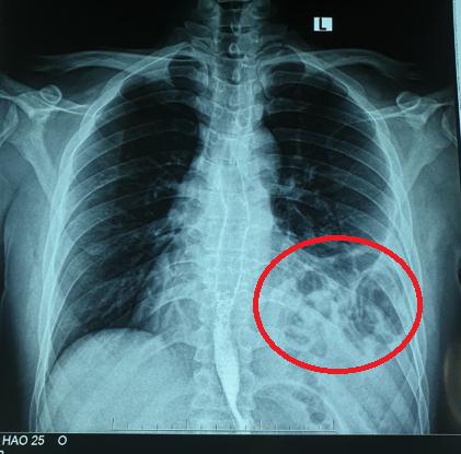 Hình ảnh chụp X-quang phát hiện bóng khí của bệnh nhân