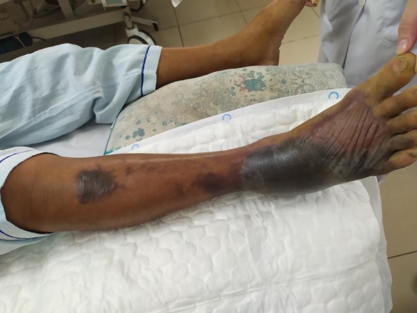 Bệnh nhân được gia đình đưa đến BV tỉnh, được chẩn đoán sốc nhiễm khuẩn với nhiều nốt phỏng nước hoại tử đen lan rộng cả cẳng chân.