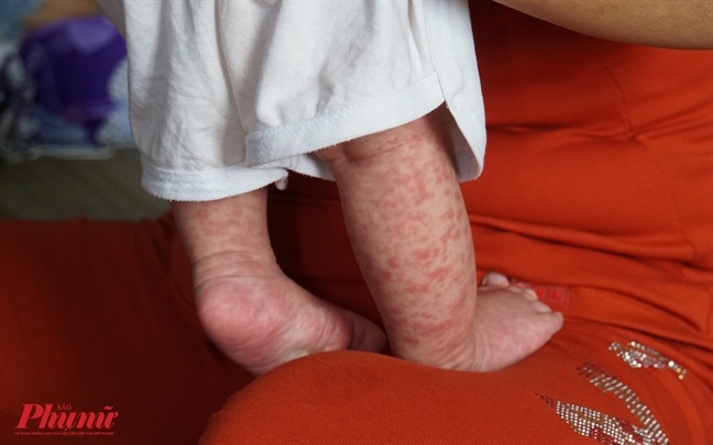 Trẻ mắc bệnh sởi điều trị tại Bệnh viện Bệnh nhiệt đới TPHCM