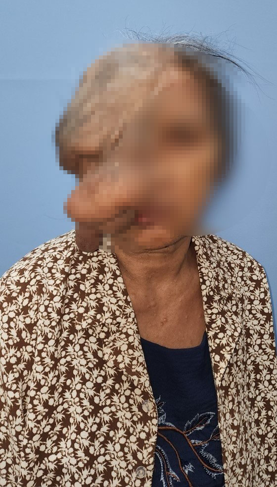 Khuôn mặt của cụ bà 73 tuổi bị khối u dị dạng che lấp, ăn cả vào mắt, xương sọ khiến thoát vị não