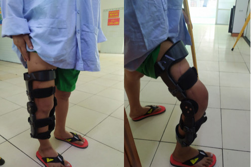 Chân của nam bệnh nhân đang hồi phục khả quan, có thể đi đứng, co gập sau phẫu thuật