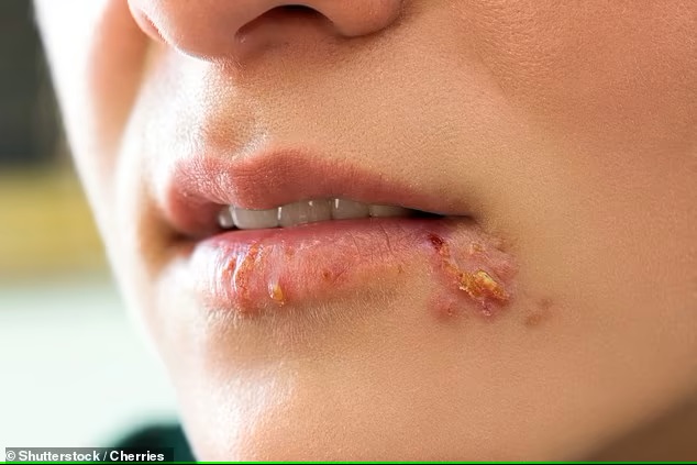 Loại virus phổ biến gây ra các vết loét và mụn giộp ở miệng hoặc bộ phận sinh dục có thể là chìa khóa của phương pháp điều trị ung thư mới
