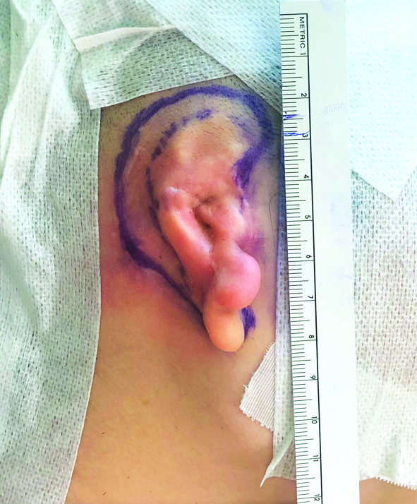 Vị trí cấy ghép khung sụn tai bằng sụn sườn của một bệnh nhân được phẫu thuật tạo hình vành tai tại Bệnh viện Đại học Y Dược TP.HCM - ẢNH: M.T.