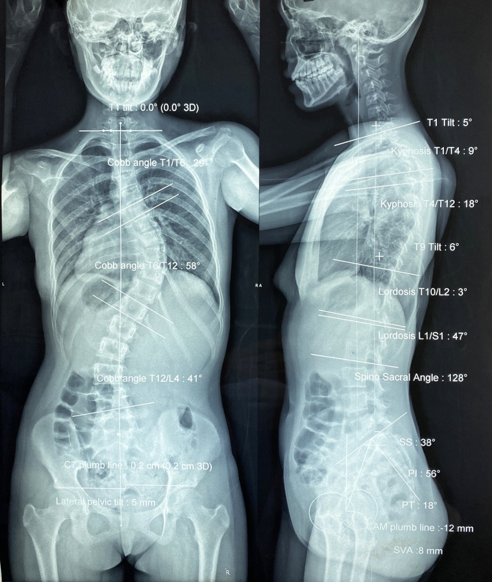 Hình X-quang cột sống của một bệnh nhi bị cong vẹo, phải phẫu thuật - ẢNH: T.H.
