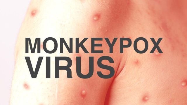 Có hơn 28.000 người ở Hoa Kỳ đã bị nhiễm đậu mùa khỉ kể từ khi bệnh bắt đầu bùng phát vào tháng 5