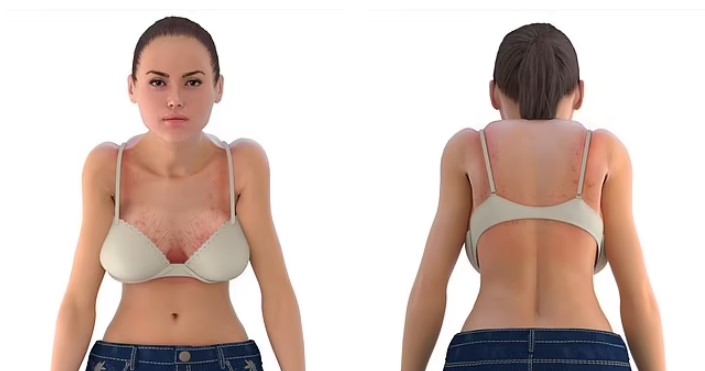Đây là tất cả các triệu chứng của việc mặc áo ngực kém vừa vặn trong nhiều năm. 