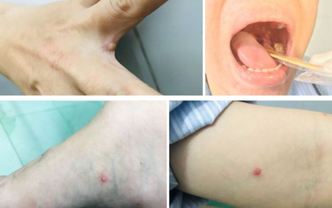 Hình ảnh ban của bệnh nhân mắc đậu mùa khỉ đầu tiên ở Việt Nam