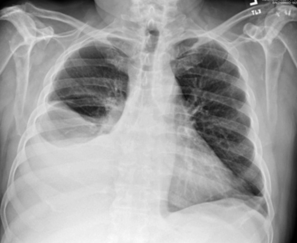 Bệnh nhân mắc hội chứng móng tay vàng bị biến chứng tràn dịch màng phổi  - ẢNH: H.V
