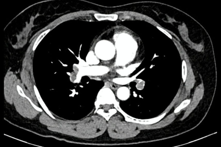 Hình ảnh chụp CT của nữ bệnh nhân cho thấy chị bị huyết khối khá lớn ở phổi, ảnh BV TP.Thủ Đức