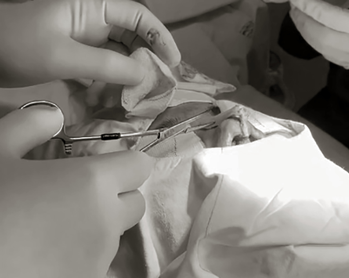 Bác sĩ phẫu thuật lấy thanh nâng mũi cho một bệnh nhân bị biến chứng vì làm đẹp ở các cơ sở không đủ tiêu chuẩn - ẢNH: PHẠM AN