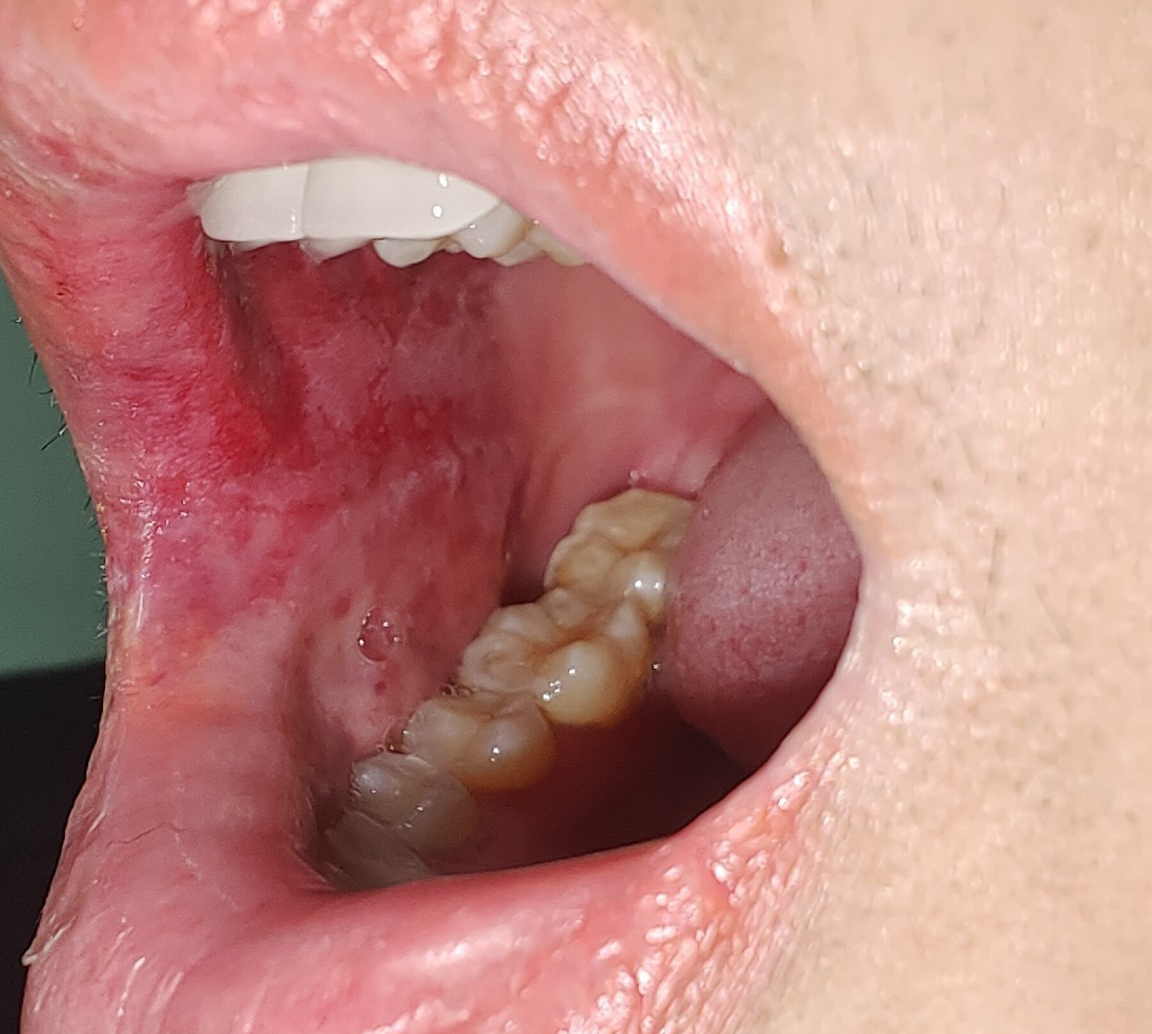 Trong miệng của bệnh nhân, tại vùng má cũng có các vết trợt loét. Ảnh: Q. H.