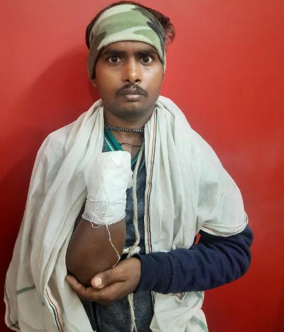Shakil Mohammad đã bị mất bàn tay phải vào chiếc máy ép nặng 200 tấn mà ông đang làm việc vào ngày 14 tháng 11 tại một nhà máy ở Faridabad. ẢNH ST: DEBARSHI DASGUPTA\
