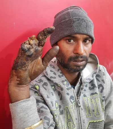 Brajesh Kumar bị mất 3 ngón tay trên bàn tay phải do bị thương khi đang làm việc trên một chiếc máy ép vận hành thủ công ở Faridabad vào ngày 28/9. ẢNH ST: DEBARSHI DASGUPTA