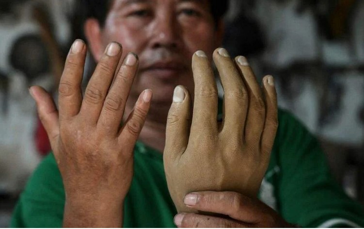 Ông Ali Saga trưng bày một bàn tay giả (phải) khi so sánh nó với bàn tay của chính mình trong xưởng của ông ở Tangerang. ẢNH: AFP