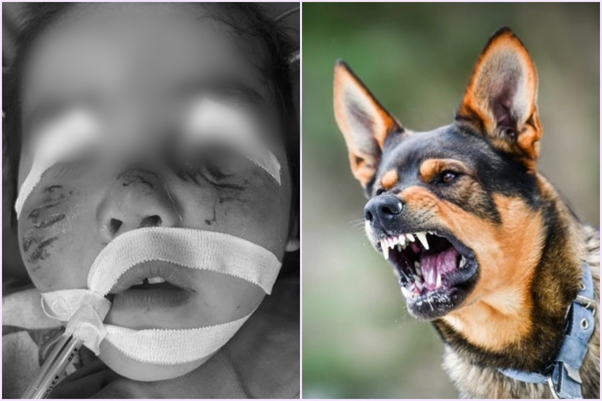 Vết thương trên khuôn mặt trẻ do chó nuôi gây ra.
