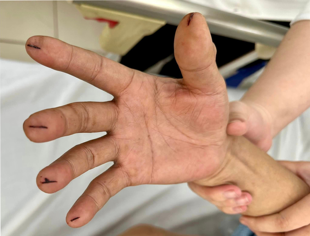 Nam bệnh nhân bị dao lam rạch sâu 5 đầu ngón tay để cấp cứu