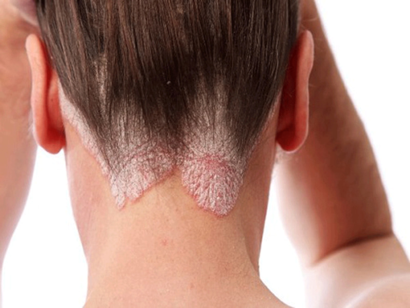 Liệu trình trị nấm ngứa da đầu sẽ kéo dài từ 1-2 tháng tùy triệu chứng nhẹ hay nặng của người bệnh.