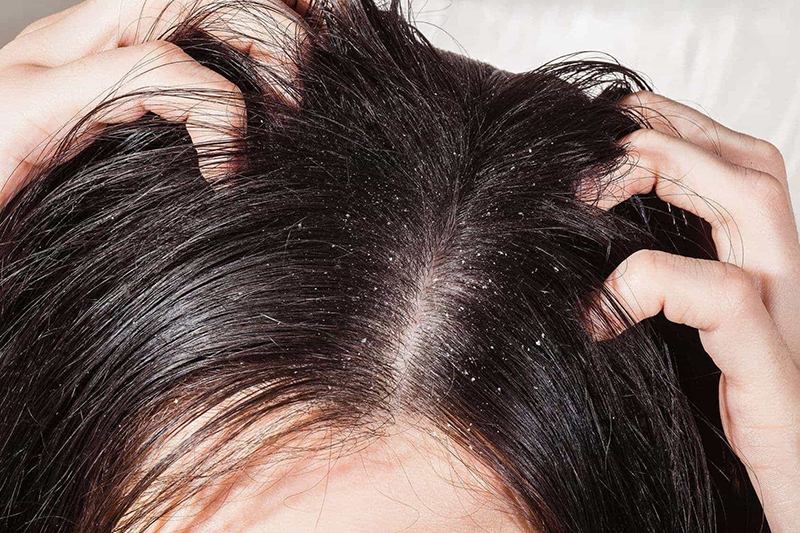 Nấm da đầu không chỉ dễ lây nhiễm mà còn dễ bị tái đi tái lại.