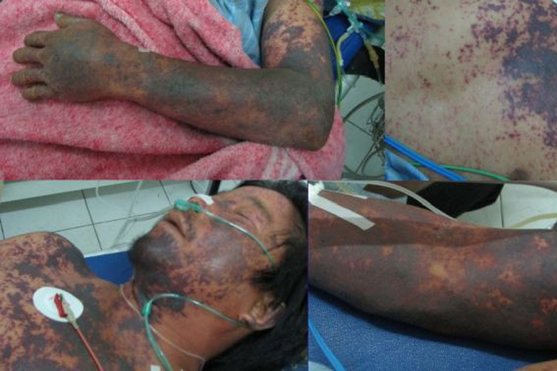 Hình ảnh một bệnh nhân bị nhiễm khuẩn huyết do liên cầu lợn - Ảnh: Bệnh viện cung cấp