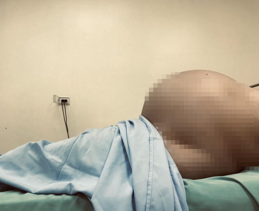 Khối u tử cung khổng lồ khiến người phụ nữ 65 tuổi như đang ở cuối thai kỳ
