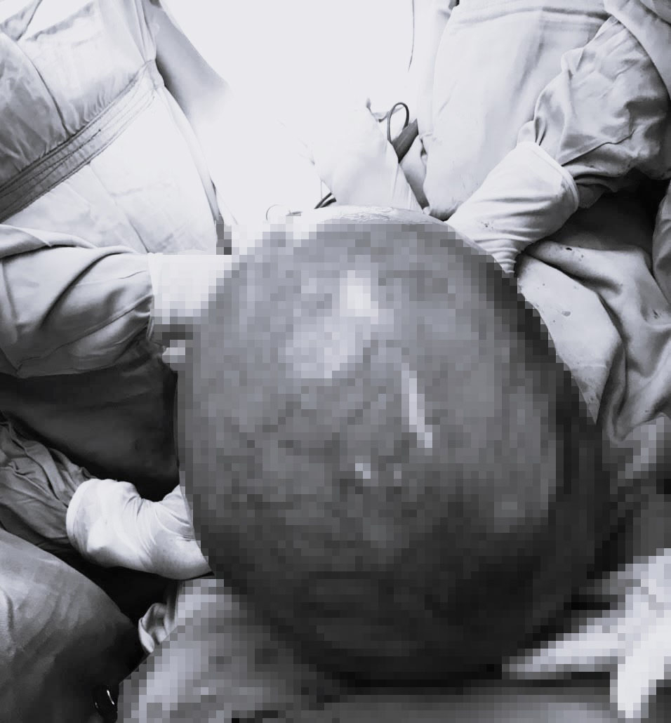 Khối u tử cung khổng lồ hàng ngàn ca có một khiến các bác sĩ Bệnh viện K phải ngỡ ngàng