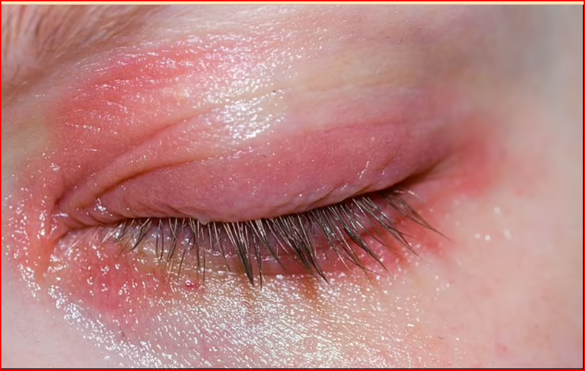 Nhà khoa học mỹ phẩm Carly Musleh cho biết: 'Vùng da trên mắt siêu nhạy cảm nên những việc như [bôi Burt's Bees ở đó] có thể gây viêm da tiếp xúc'