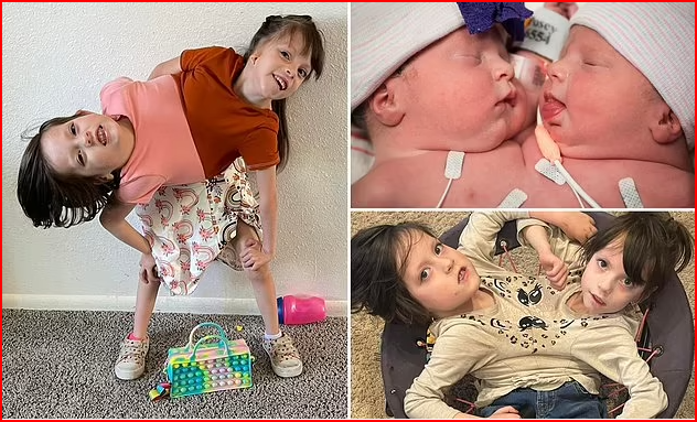 Cặp song sinh dính liền Callie và Carter sinh năm 2017 ở Idaho (Mỹ) từng được dự đoán chỉ sống được khoảng vài tuần tuổi nhưng 2 em đã chứng minh bản năng sinh tồn là rất lớn. Hiện 2 bé vẫn mạnh khỏe và đang chuẩn bị vào mẫu giáo.